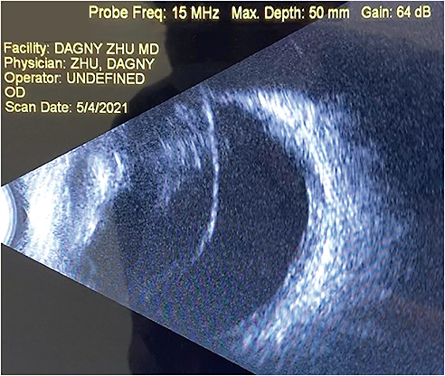 Figure 4. Dense vitreous opacities with complete PVD on B-Scan ultrasound.