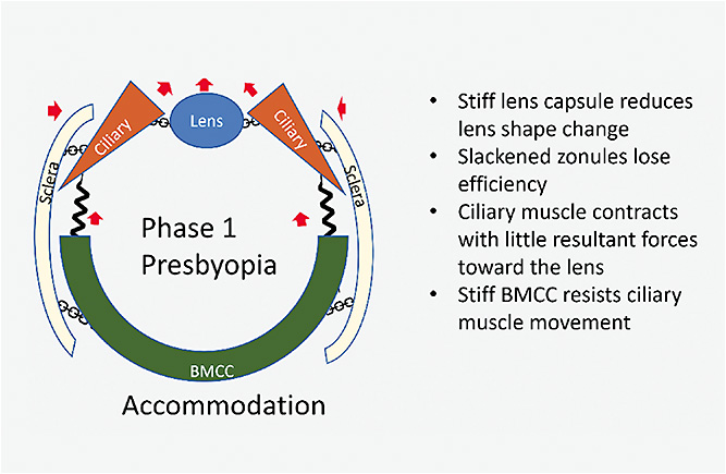 Figure 4. Kinematic Chain of accommodation (Phase 1) in the presbyopic eye.