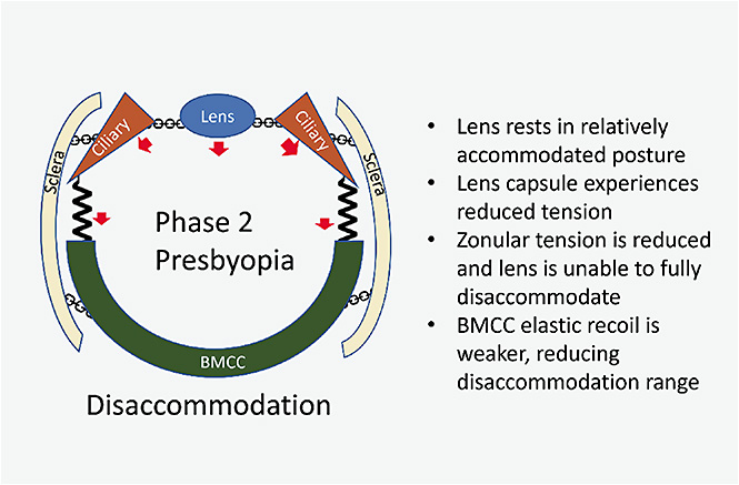 Figure 5. Kinematic Chain of disaccommodation (Phase 2) in the presbyopic eye.