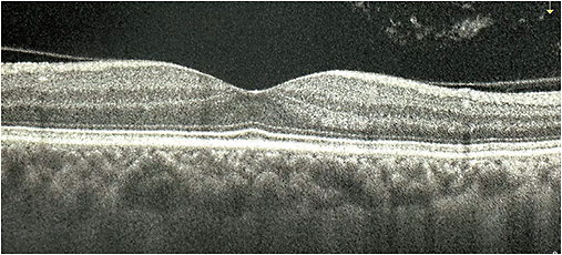 Figure 3. Vitreous opacities with incomplete paramacular PVD on optical coherence tomography (OCT).