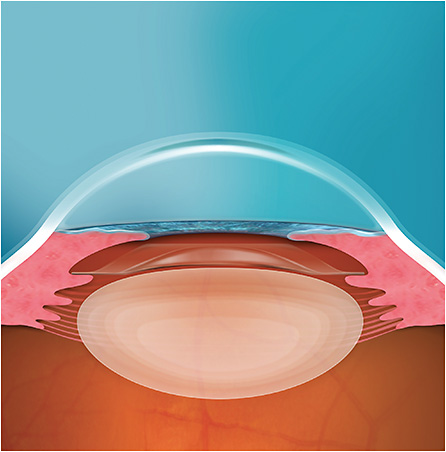 Figure 2. The EVO ICL is implanted into the ciliary sulcus, sitting anterior to the crystalline lens and posterior to the iris.