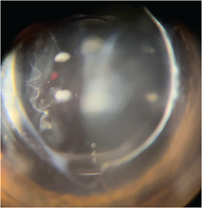 Figure 2. Slit lamp view of an anterior vitreous curly “strand” adjacent to a denser “cloud” behind a trifocal toric IOL.