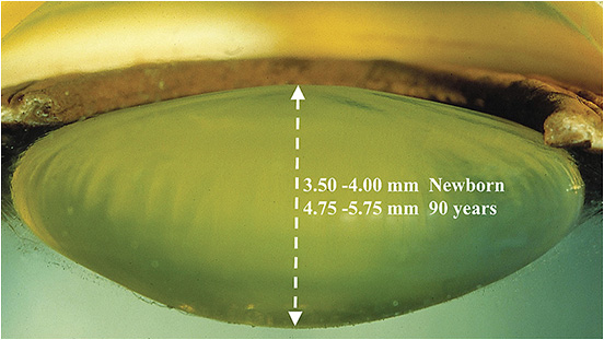 Figure 3. The shape of the lens in Phase 0 changes throughout life, becoming thicker with age.IMAGE COURTESY OF JOHN MARSHALL, PHD.