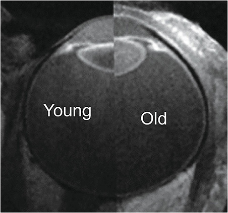 Figure 2. Eye of a young (left) versus old (right) subject in phase 0. In presbyopia, the Bruch’s membrane-choroid complex no longer pulls the lens back into the same position as a young eye.26